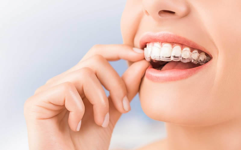 Wireless Orthodontic Treatment (Invisalign) – DentAgora Ağız ve